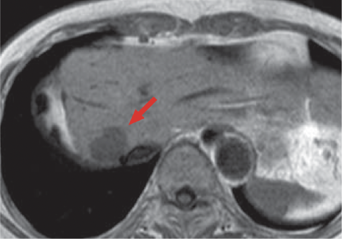 h) Pre-contrast, T1-weighted imaging