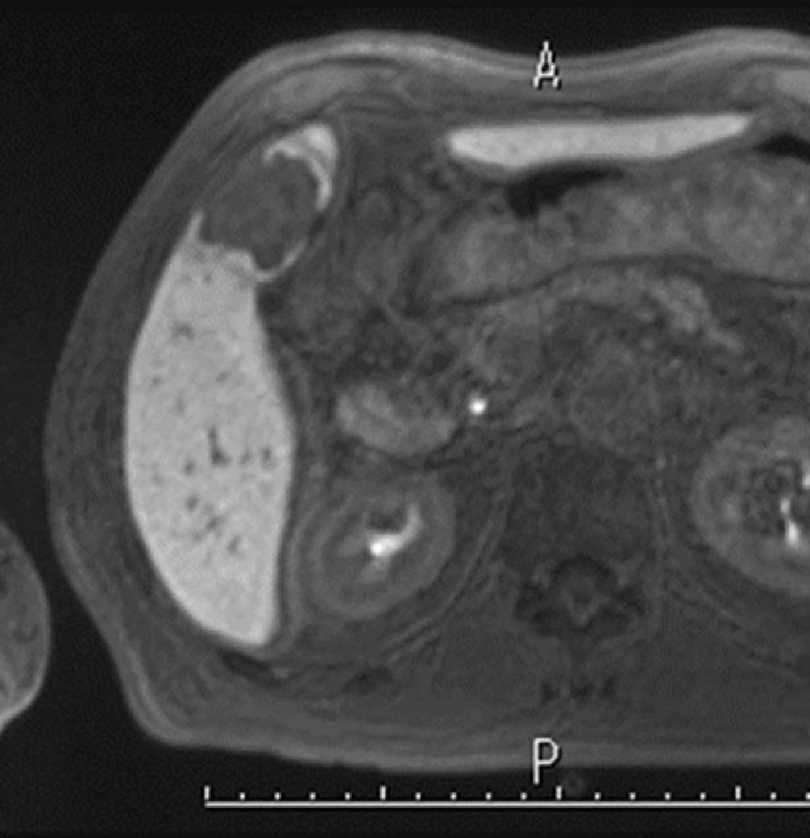 Fig. 3. EOB-MRI hepatobiliary phase