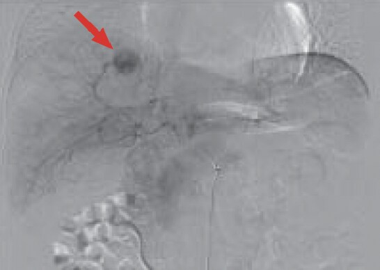 a) Hepatic arteriography