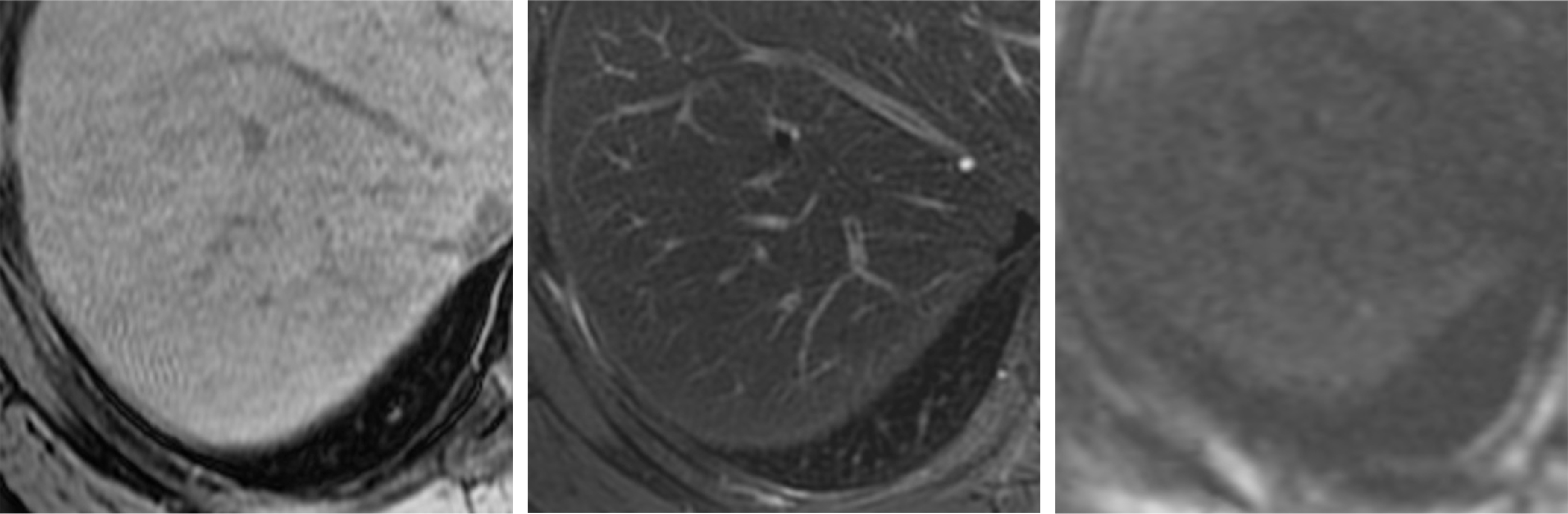 Fig. 2. T1-, T2- and diffusion-weighted imaging