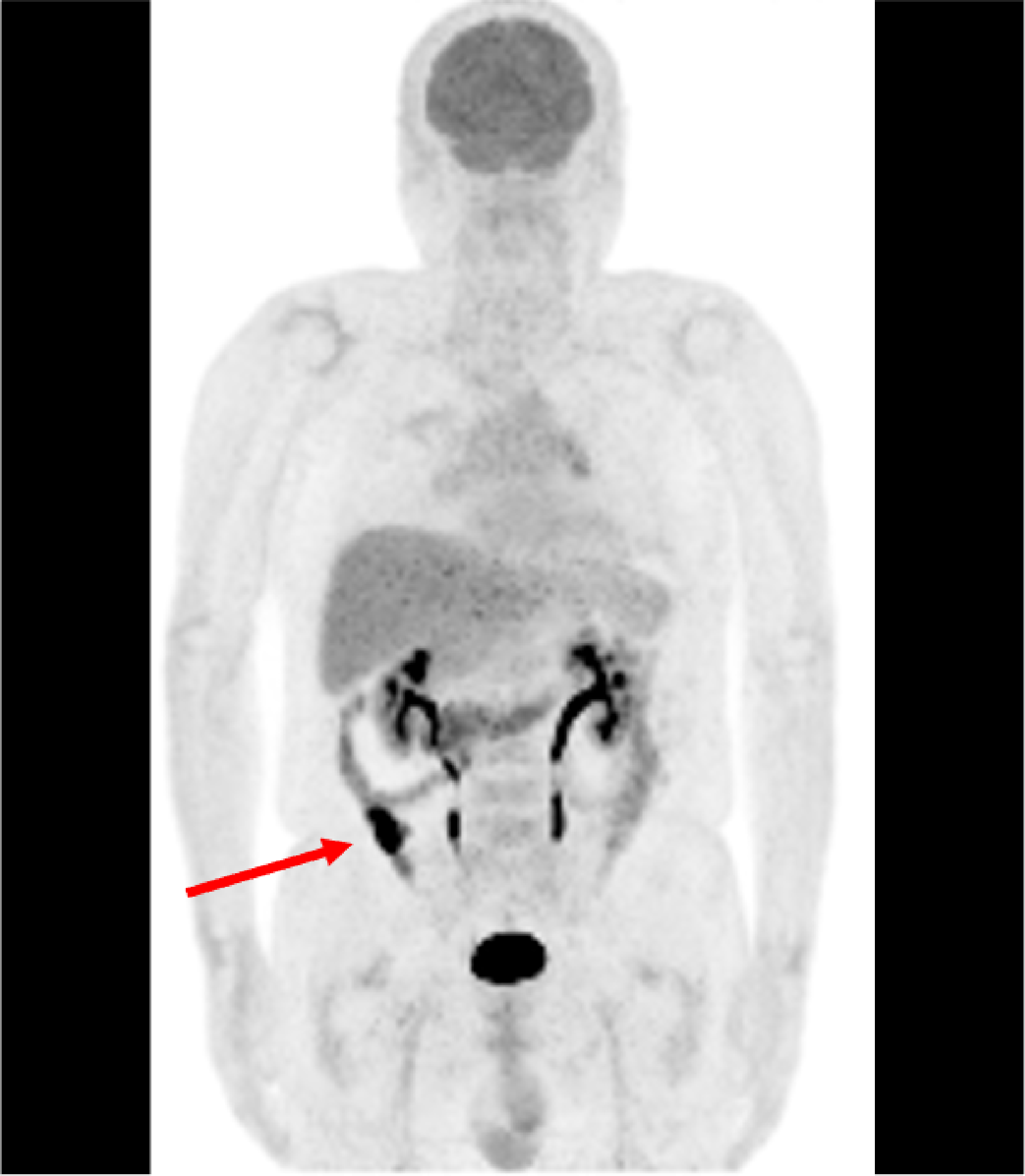 Fig. 2. FDG-PET MIP image