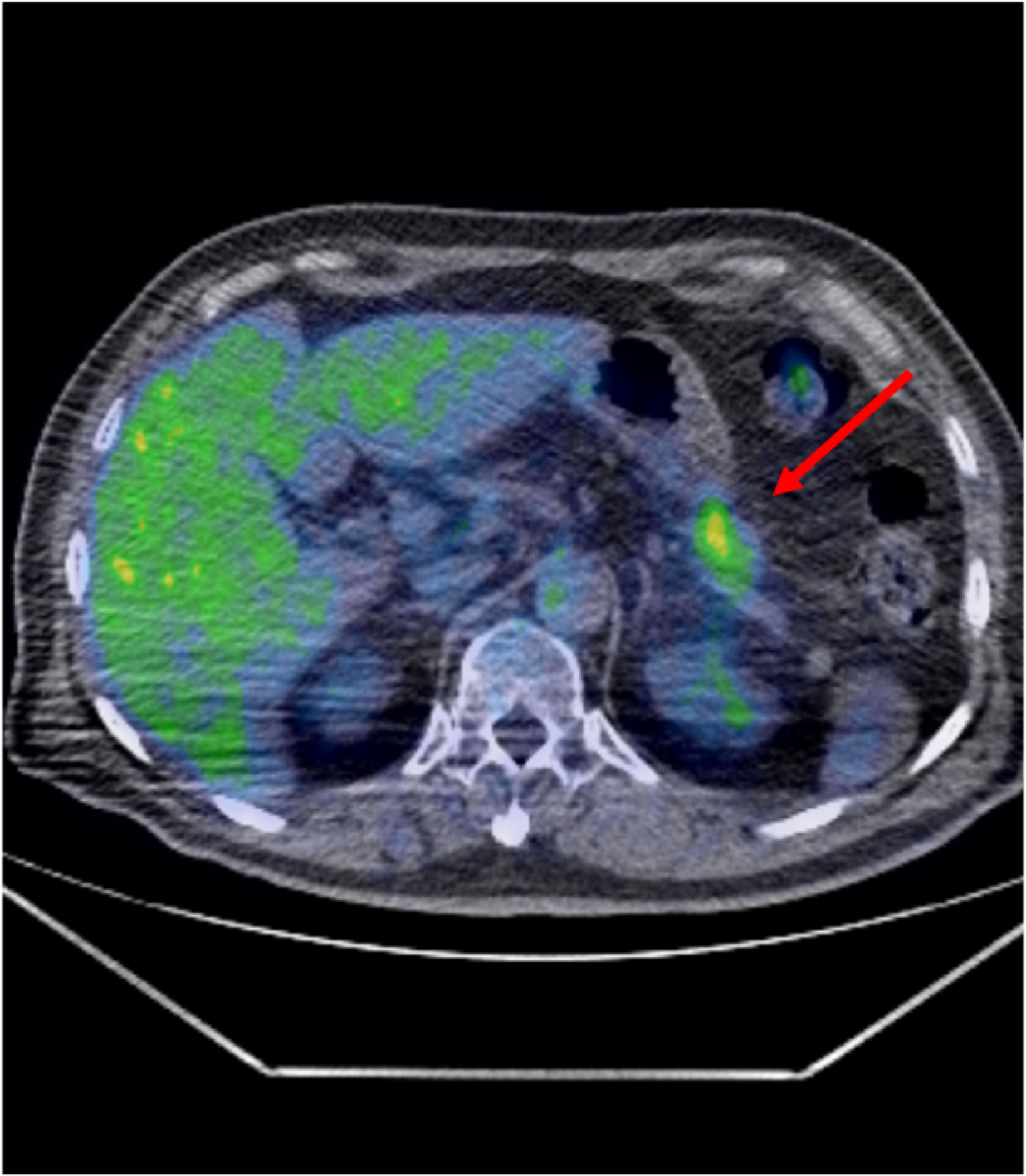 Fig. 3. FDG-PET/CT fusion images