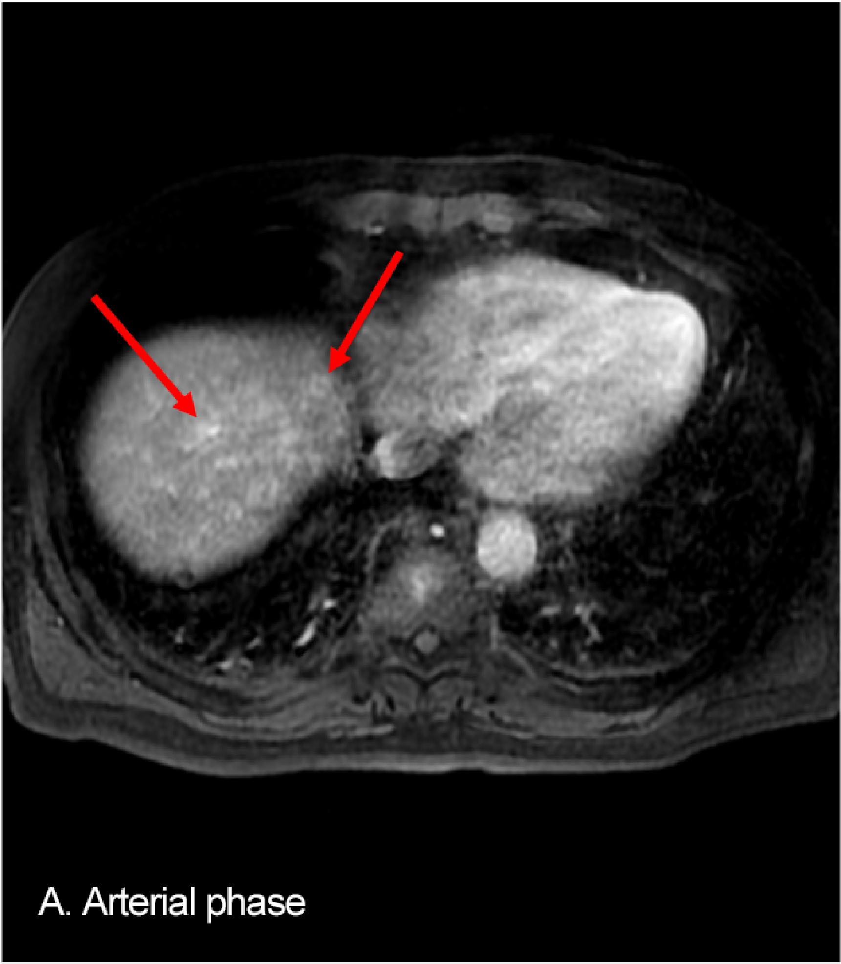 Fig. 4. EOB-MRI: A: arterial phase; B: hepatobiliary phase; C: diffusion-weighted image; D: ADC map
