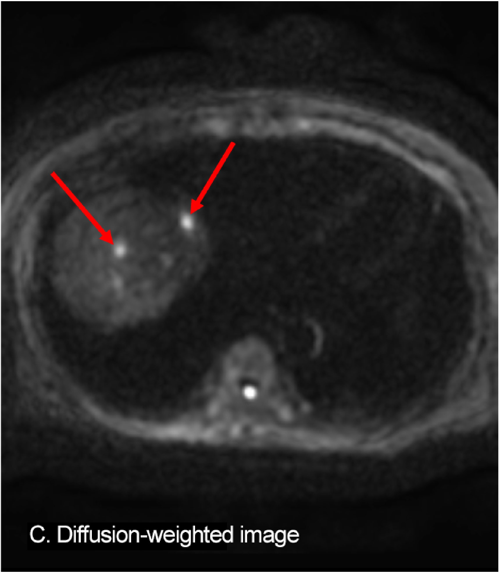 Fig. 4. EOB-MRI: A: arterial phase; B: hepatobiliary phase; C: diffusion-weighted image; D: ADC map