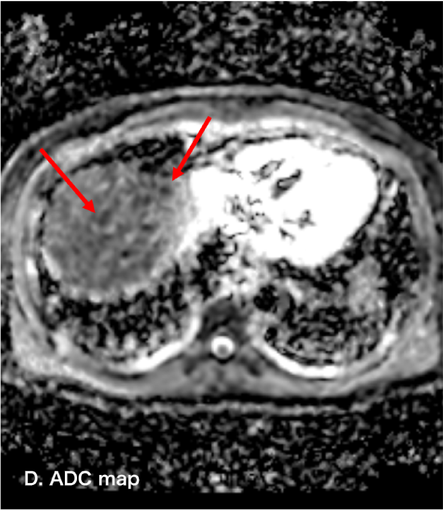 Fig. 4. EOB-MRI: A: arterial phase; B: hepatobiliary phase; C: diffusion-weighted image; D: ADC map
