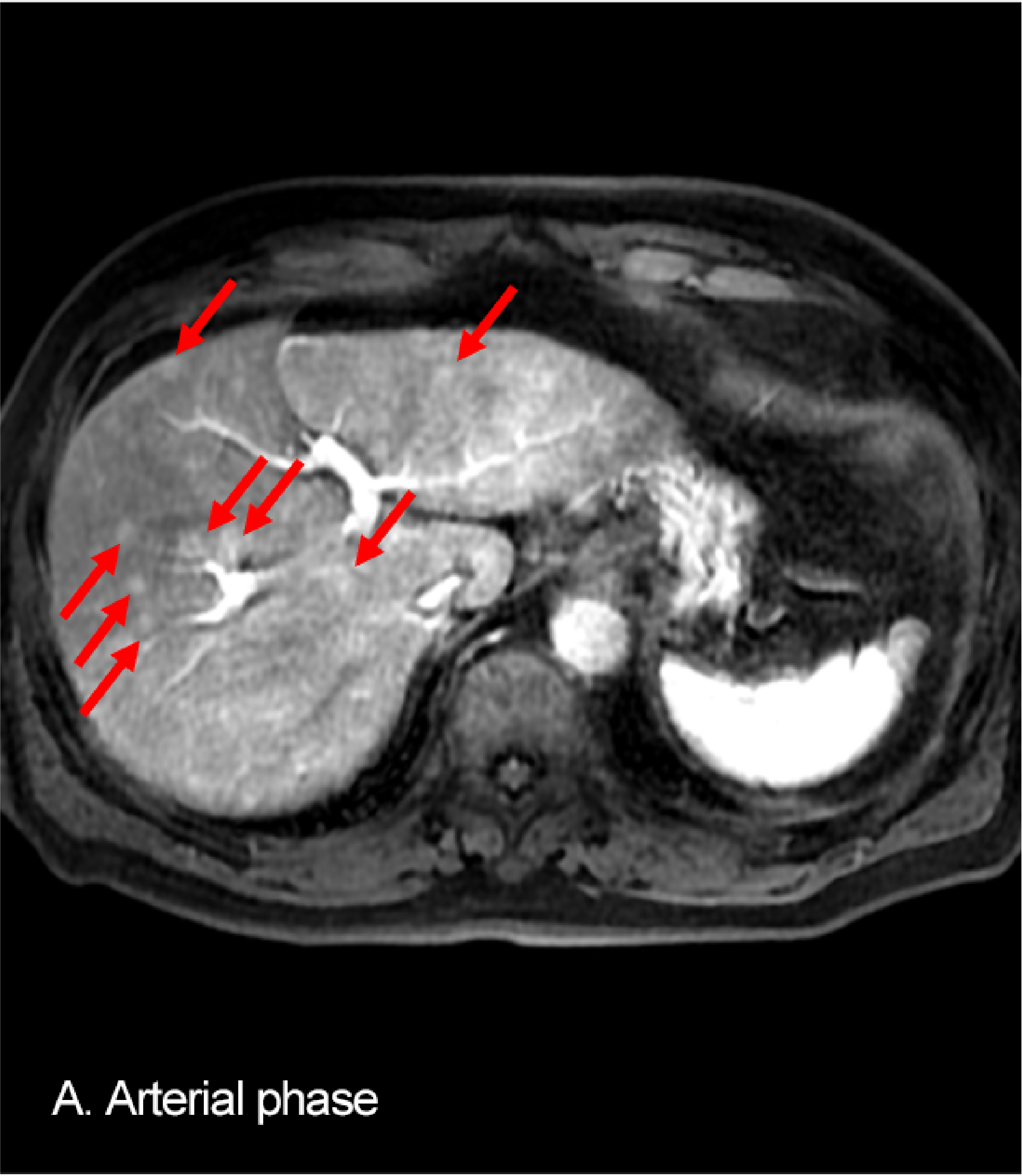 Fig. 5. EOB-MRI: A: arterial phase; B: hepatobiliary phase; C: diffusion-weighted image; D: ADC map