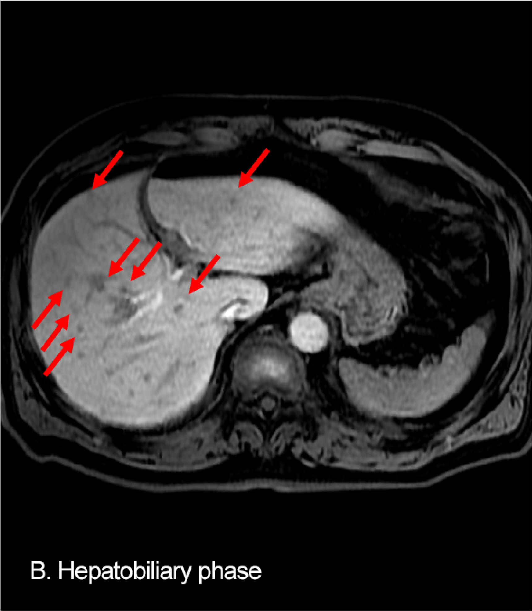 Fig. 5. EOB-MRI: A: arterial phase; B: hepatobiliary phase; C: diffusion-weighted image; D: ADC map