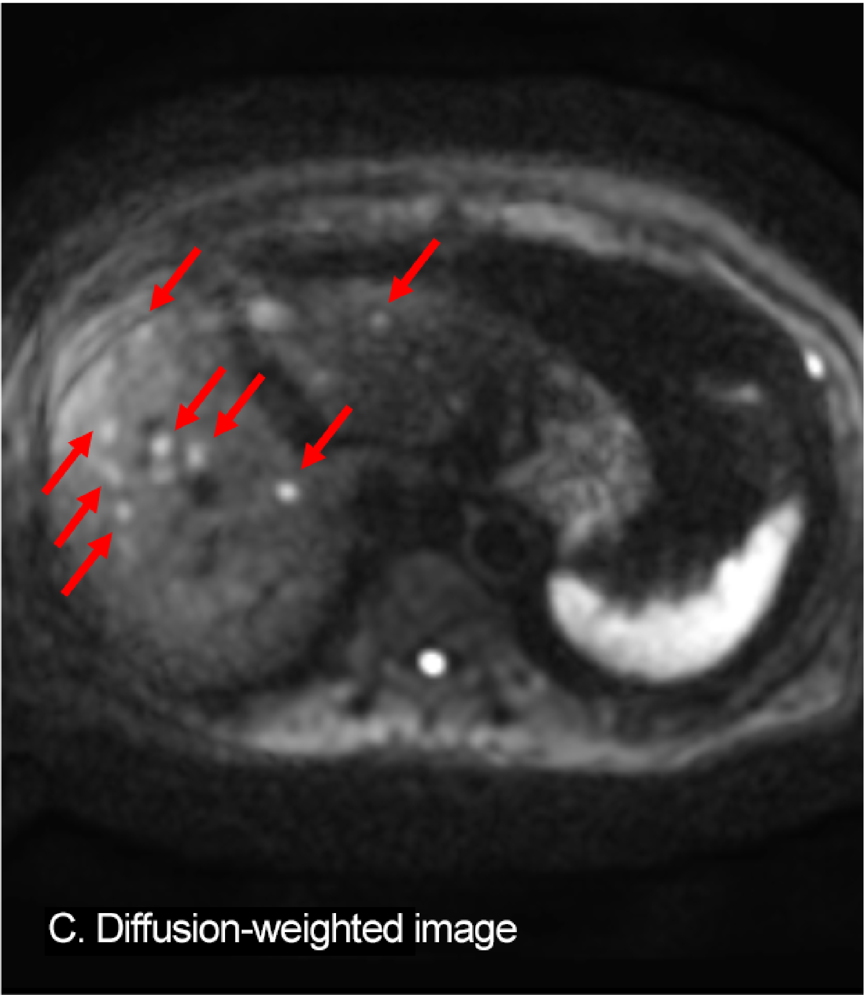Fig. 5. EOB-MRI: A: arterial phase; B: hepatobiliary phase; C: diffusion-weighted image; D: ADC map