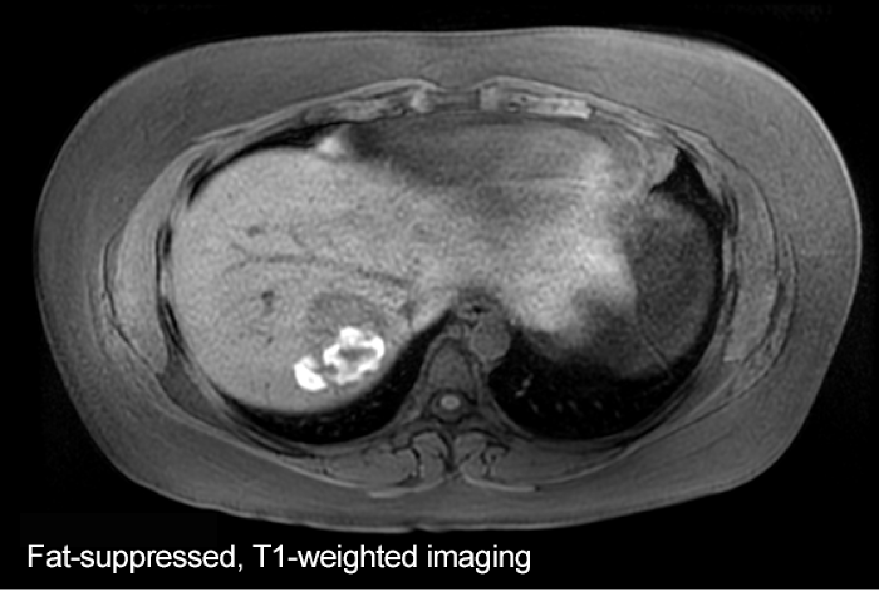 Fig. 2. MRI image, approximately 6 months after initial image