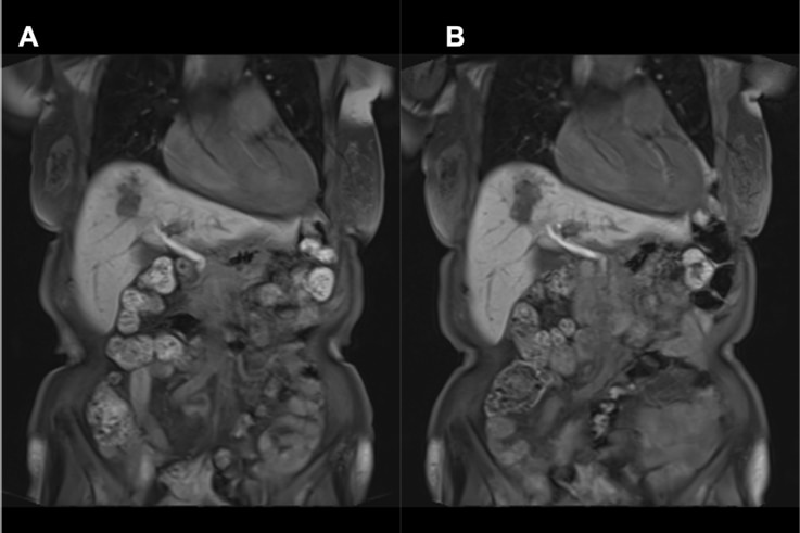 Fig. 1. Hepatobiliary phase of EOB-MRI (coronal section)