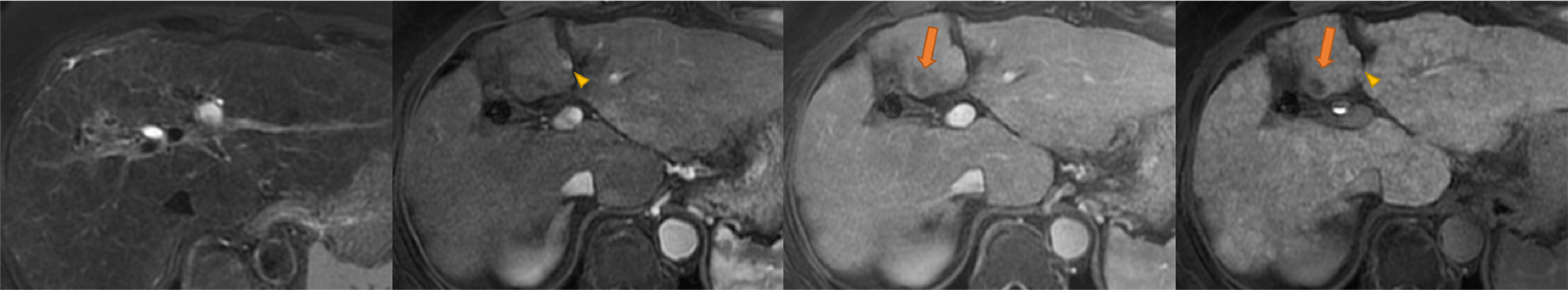 Fig. 2. EOB-MRI after 26 months (from left to right: fat-suppressed T2-weighted imaging; arterial phase; portal phase; hepatobiliary phase)