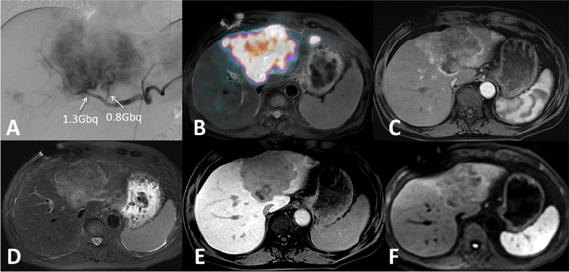 Fig. 3. Y90 radioembolization (TARE) and follow-up Gd-EOB-DTPA enhanced MRI