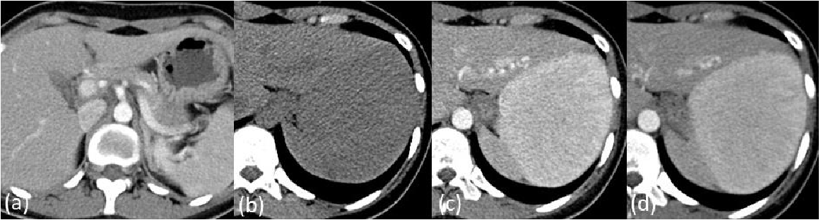 Fig. 1. Triple-phase liver CT